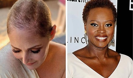 Celebrity Female Hair Loss Featured Image