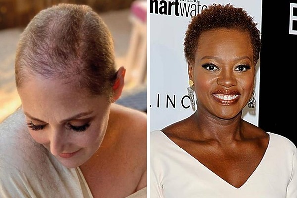 Celebrity female hair loss featured image