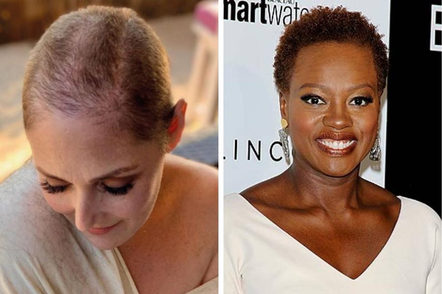 20 Female Celebrities With Hair Loss