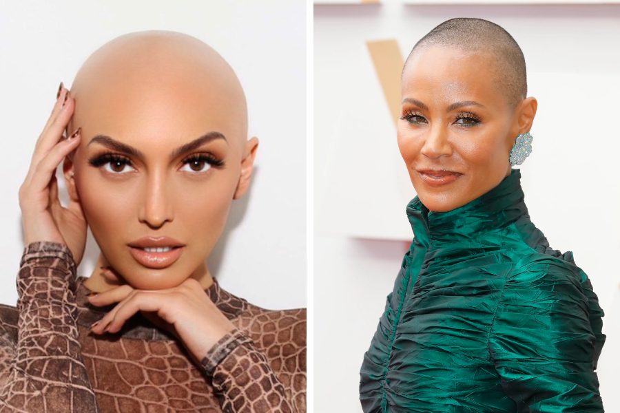 12 Celebrities With Alopecia & Hair Loss