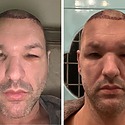 How To Prevent And Reduce Hair Transplant Swelling