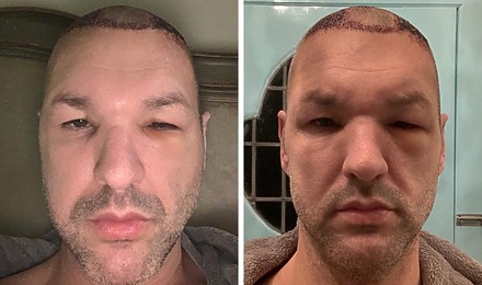 Hair Transplant Swelling Featured Image