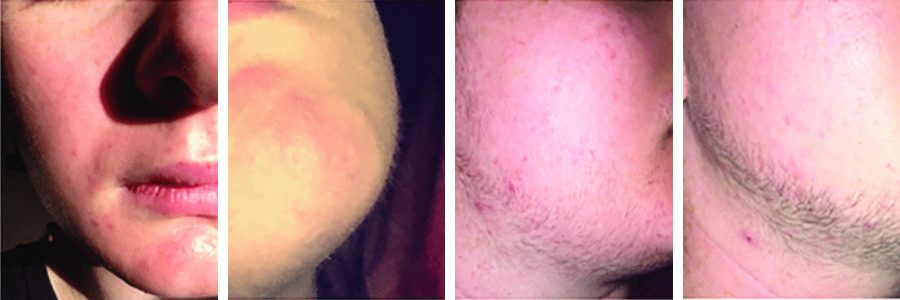 Beard growth before Minoxidil treatment; after 2 months; after 3 months; after 5 months.