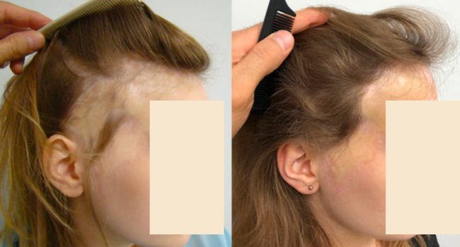 hair transplant into scars: a female patient with burns pre and post hair transplant