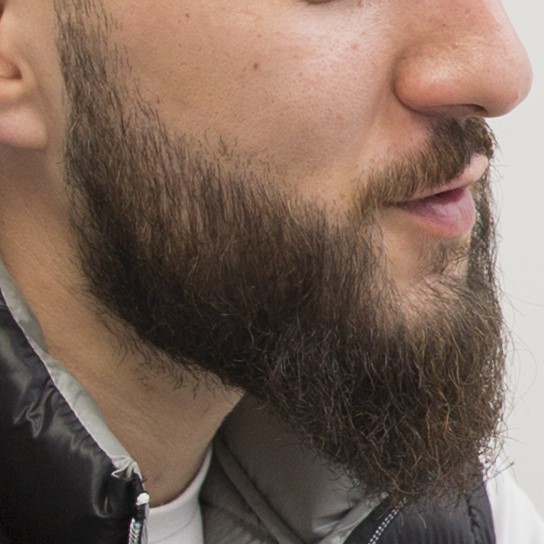 How To Fix Beard Bald Spots, Wimpole Clinic