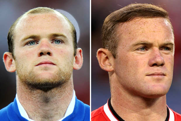 wayne rooney celebrity hair transplant before and after
