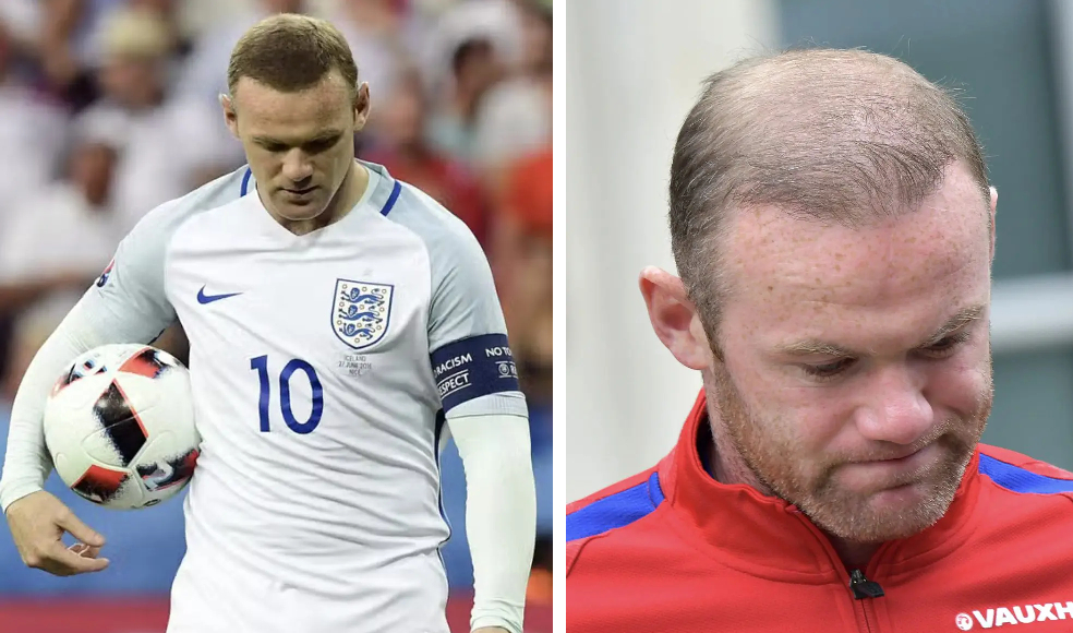 Wayne Rooney hair before and after EURO 2016