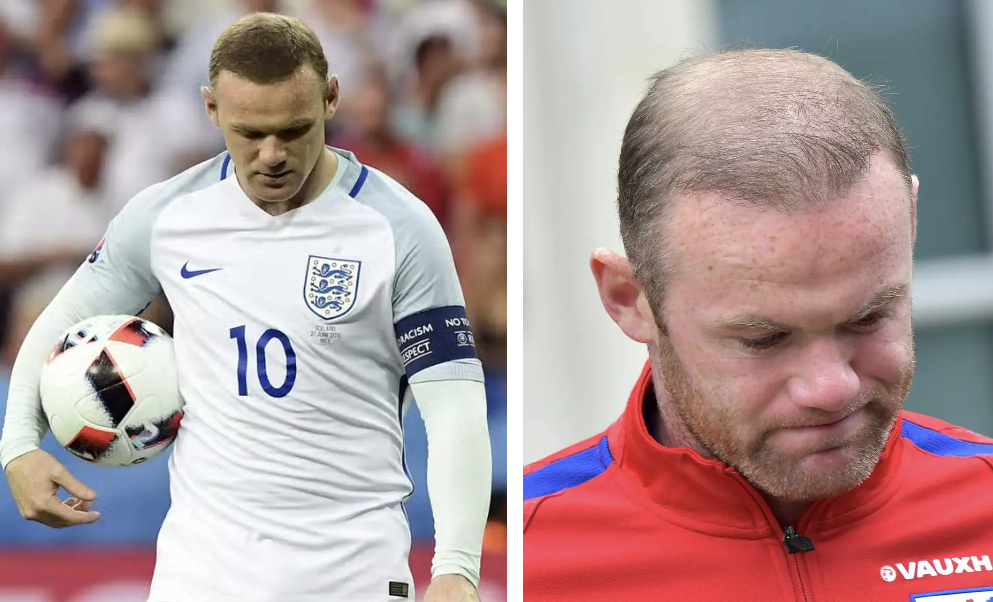 Wayne Rooney's hair transplant