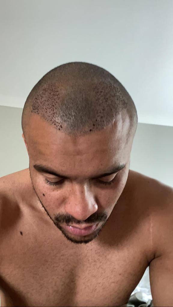 Jonathan Joseph Hair Transplant: Everything You Need To Know, Wimpole Clinic