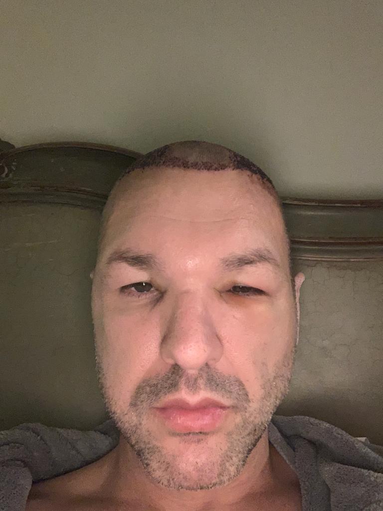 swelling on forehead and eyelids after hair transplant