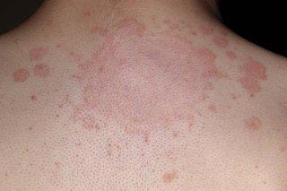 Widespread case of ringworm with individual patches as well as an irregular central ringworm rash