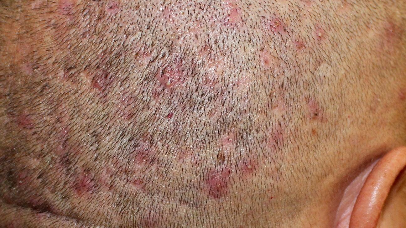 Folliculitis on a closely-shaven scalp