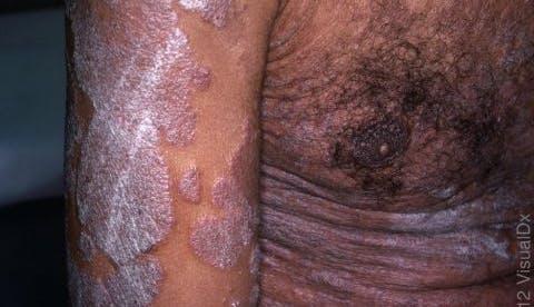 severe psoriasis on dark skin