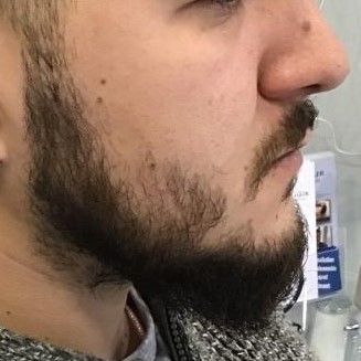 Beard Transplant, Wimpole Clinic