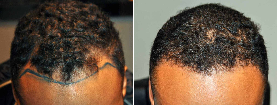 Wimpole Clinic patient before and after 500 grafts hair transplant