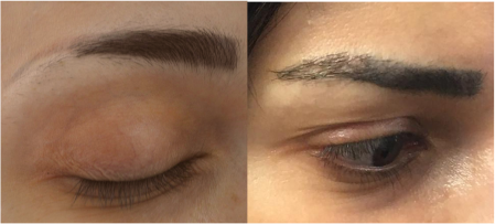 Before and after eyebrow hair transplant at the Wimpole Clinic