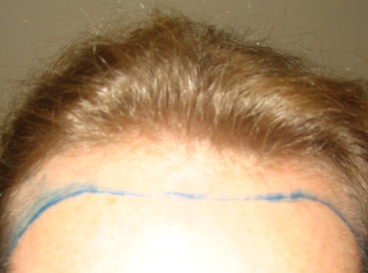 Patient with a receding hairline