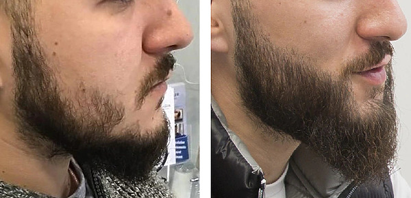 How To Fix Beard Bald Spots | Wimpole Clinic