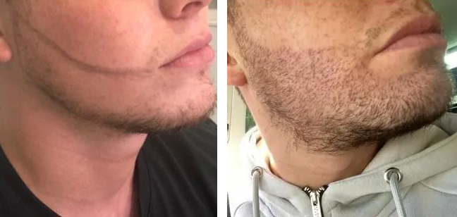 Wimpole patient before and after receiving a beard transplant
