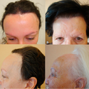 Frontal Fibrosing Alopecia: Causes, Symptoms & Treatments