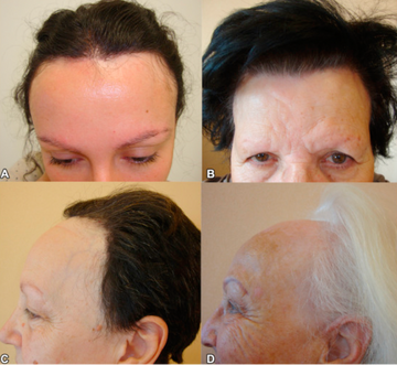 Frontal Fibrosing Alopecia Causes Symptoms Treatments