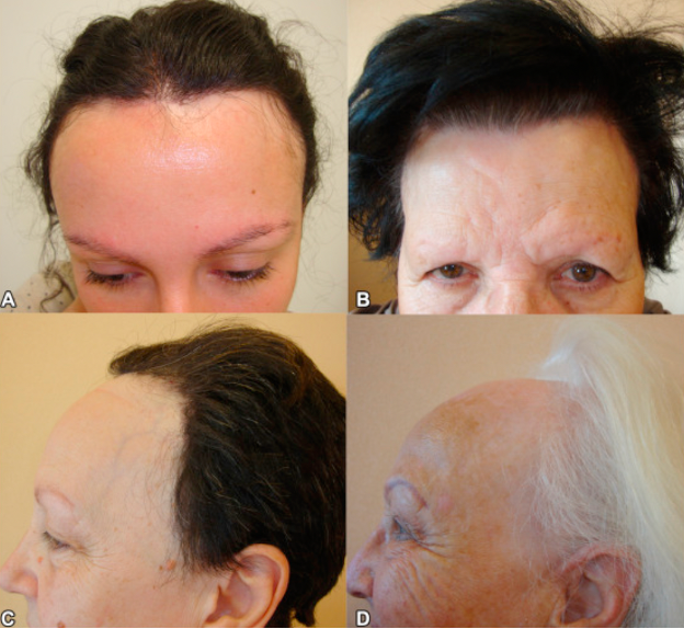 stages of frontal fibrosing alopecia