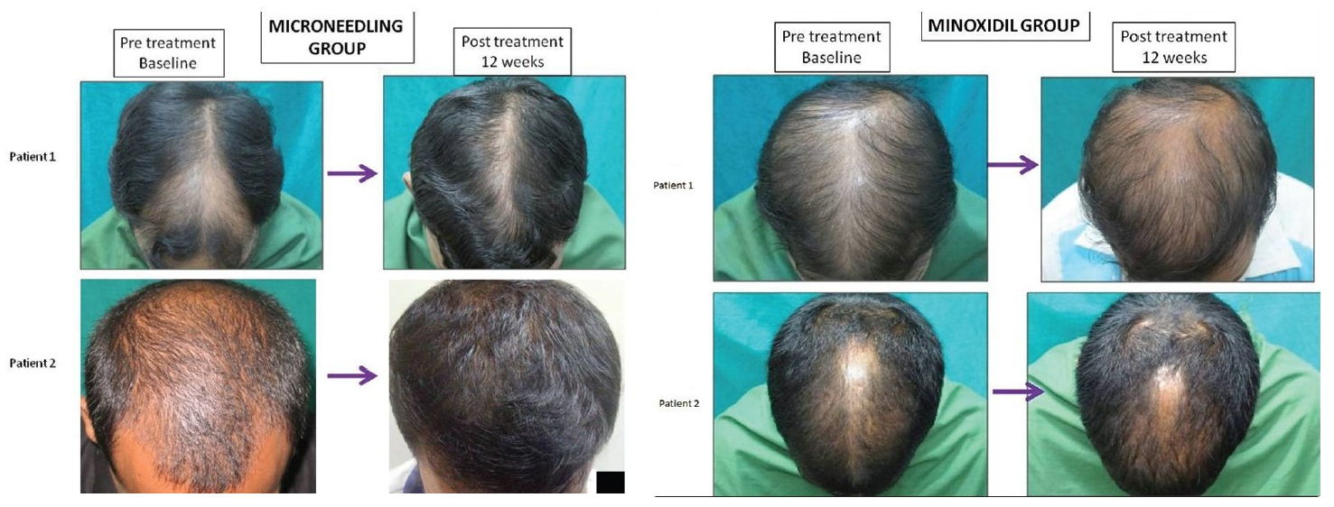 a comparison of micro needling vs. Minoxidil results for hair growth