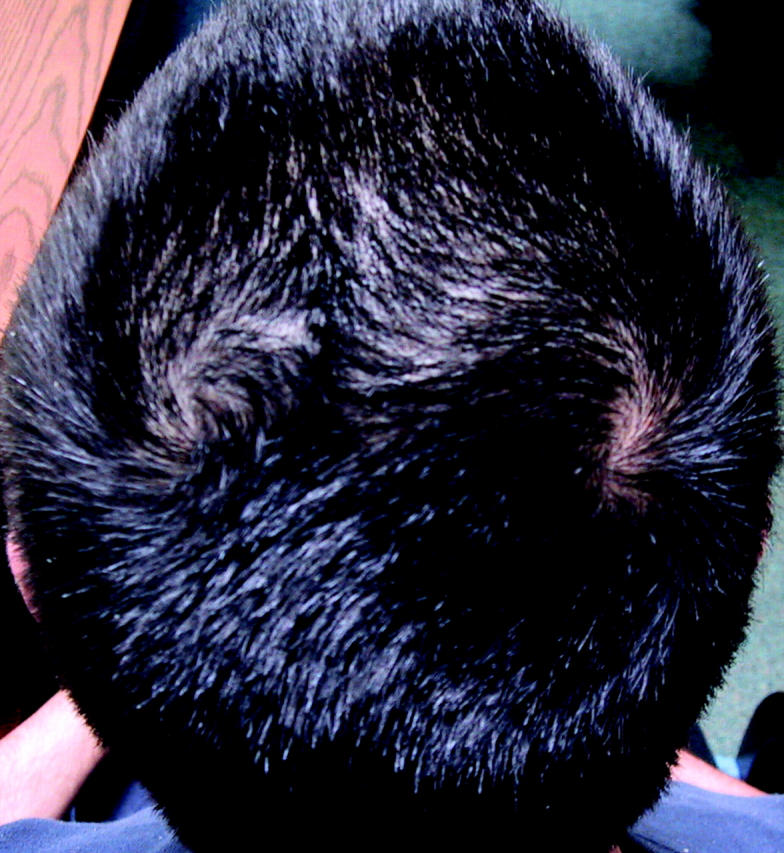 Double Crown Vs Balding: Differences, Symptoms, Treatments