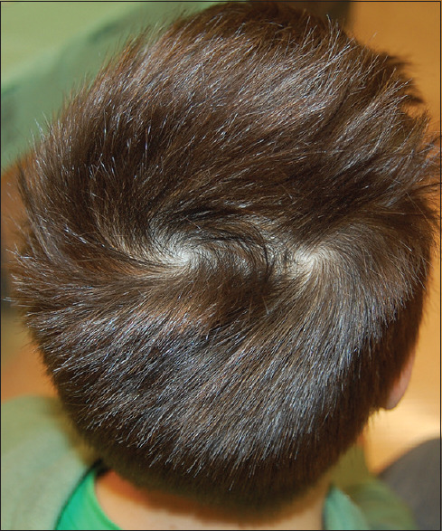 Aggregate 81+ double crown hairstyles male super hot - in.eteachers