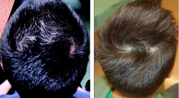 Double Crown Vs Balding Differences Symptoms Treatments