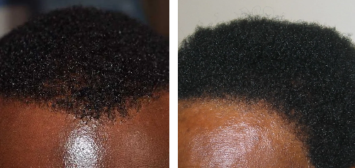 afro hair transplant results