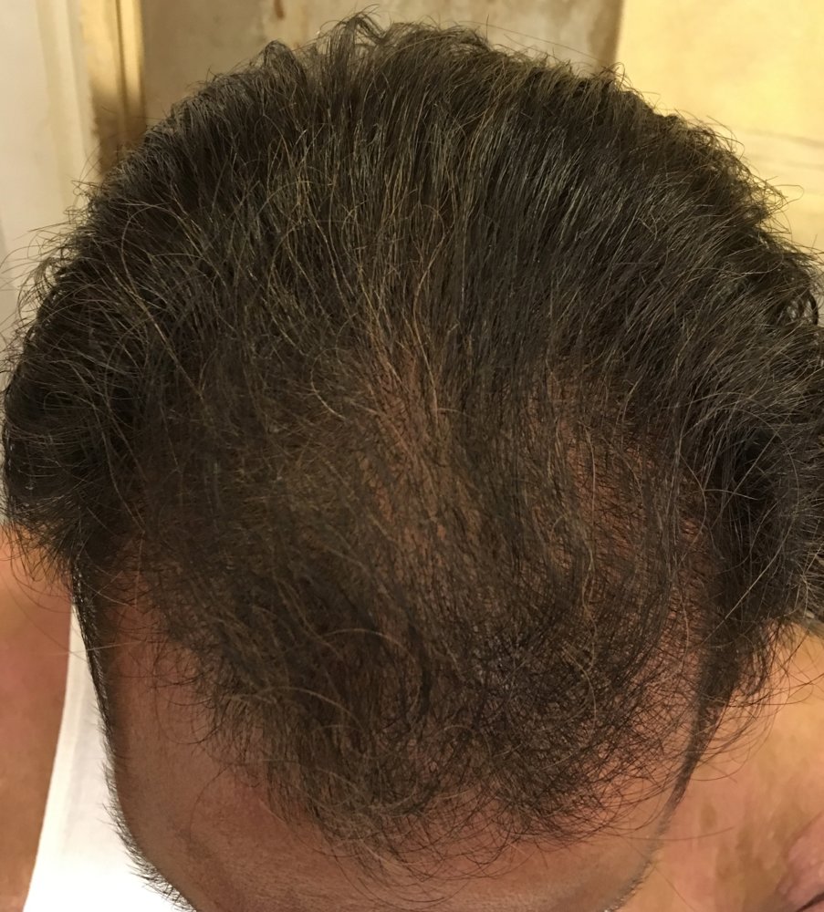 after finasteride 9 months use