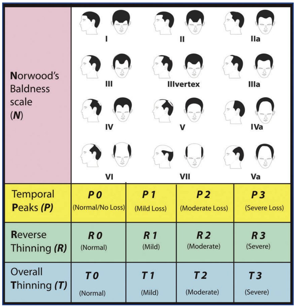 Norwood's baldness scale