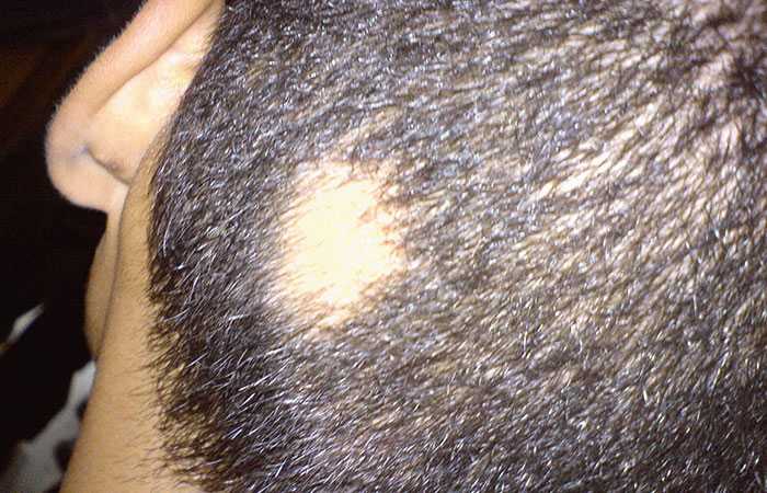 Bald-patches-treatment-advice-alopecia-areata