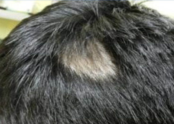 alopecia areata after minoxidil treatment