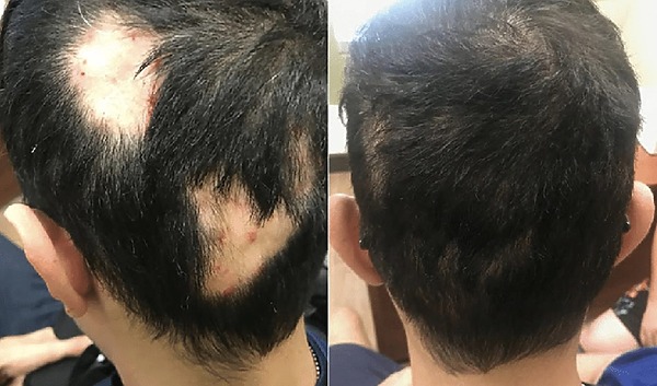 Minoxidil Before And After Photos And Results Wimpole Clinic 0640