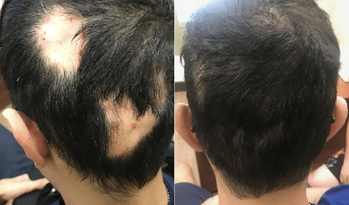 Before and after hair growth results of using corticosteroids and Minoxidil to treat alopecia areata