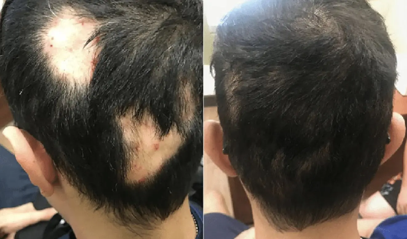 Before and after photos of Minoxidil and corticosteroids treatment in an alopecia areata patient