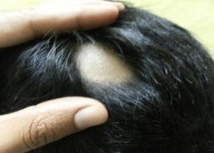 alopecia areata before minoxidil treatment
