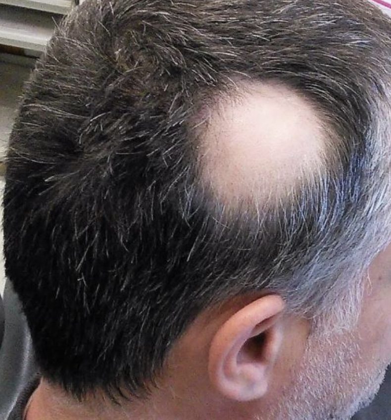 Patient with alopecia areata, leading to characteristic bald spots at the side of the head.