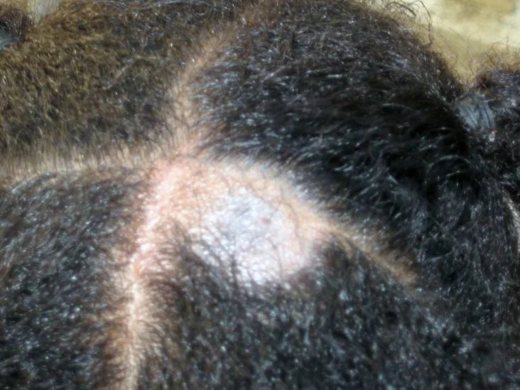 alopecia areata in a young black patient