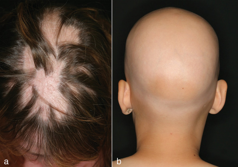 Alopecia areata (left) vs. alopecia universalis