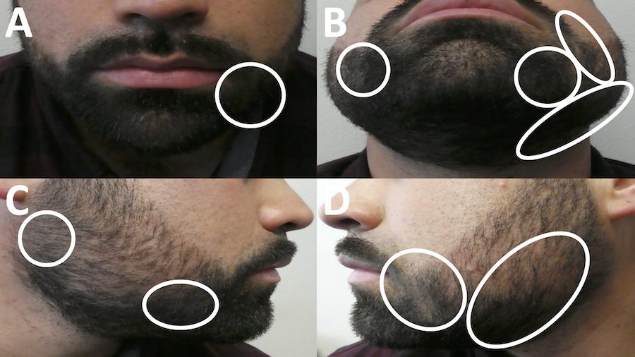 Photos of beard growth improvement due to the use of topical steroid treatments