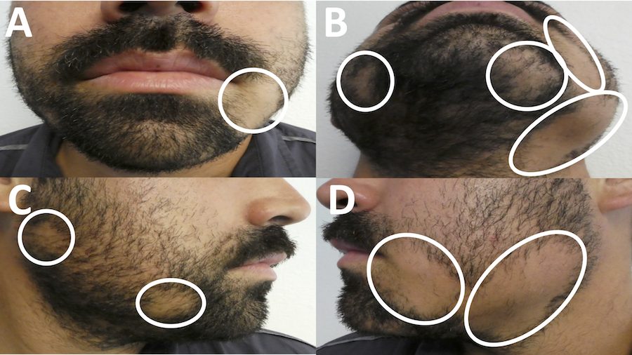 Examples of patchy beard loss on a patient suffering from alopecia barbae