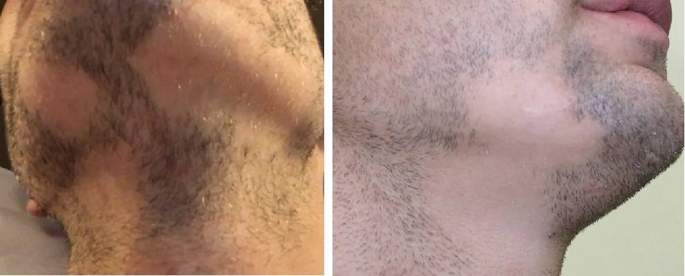 examples of patchy beards caused by alopecia barbae
