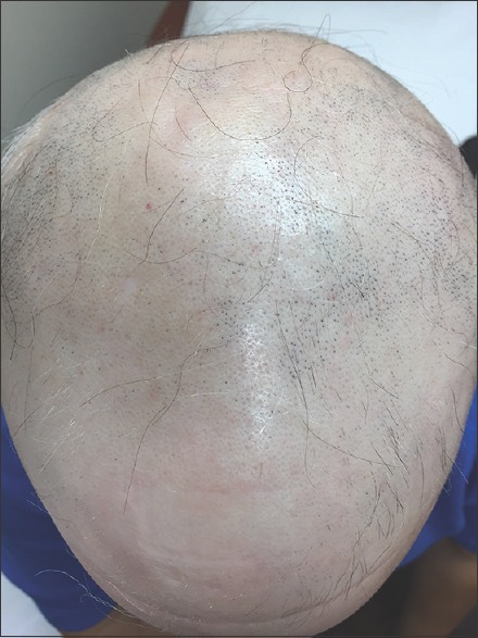 alopecia areata totalis example