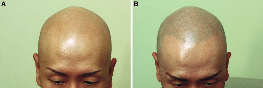 alopecia totalis smp