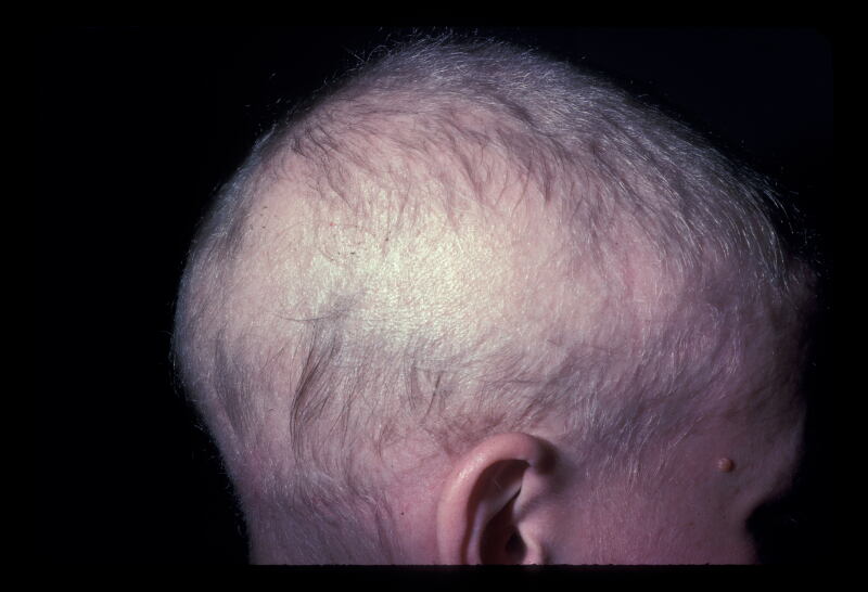 alopecia totalis with some regrowth