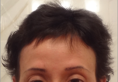 alopecia universalis after treatment