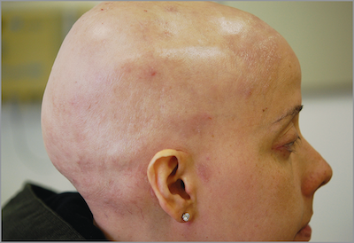 alopecia universalis before treatment